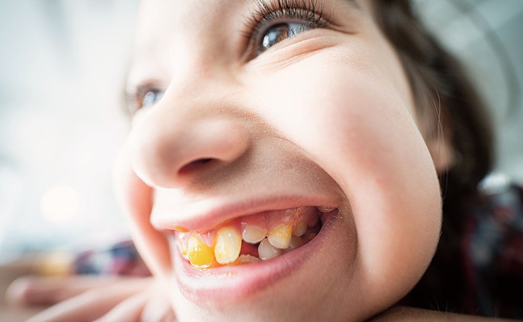 Los 'dientes de tiza' se expanden