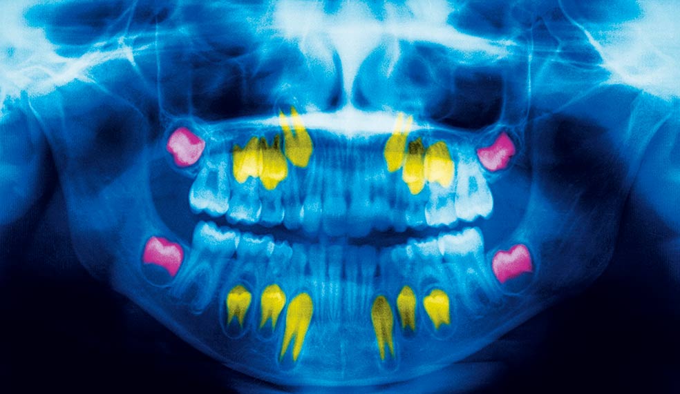 Dientes de leche (los blancos, salvo los cuatro incisivos superiores e inferiores, que ya son definitivos), permanentes en proceso de reemplazar a los de leche (amarillos) y segundos molares (rosas), los previos a que salgan las muelas del juicio. La dentadura informa de nuestras vivencias.