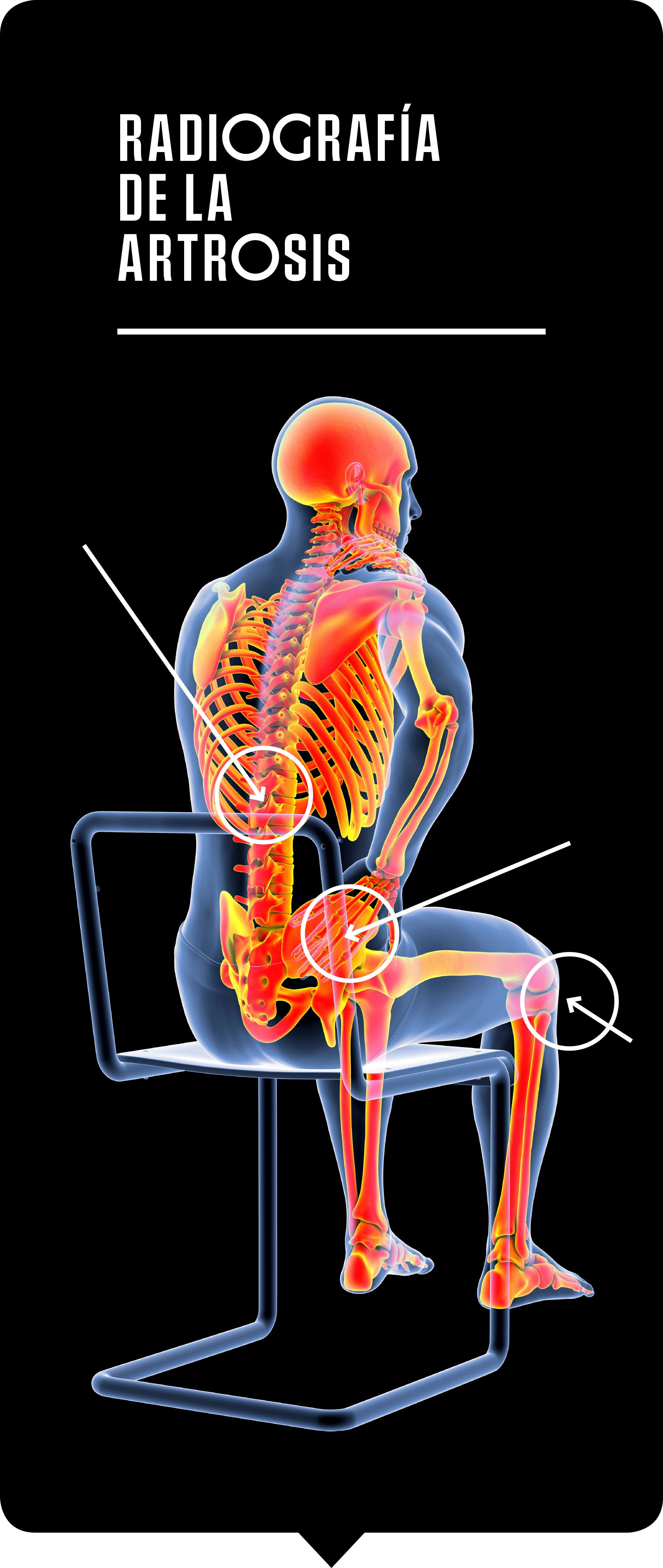 Aunque el 80 por ciento de las personas tienen dolor de espalda en algún momento de su vida, el dolor de caderas y rodillas se agrava con el tiempo.