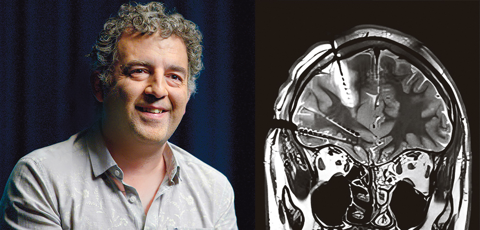 El neurocientífico y físico Rodrigo Quian Quiroga (en la imagen) descubrió la 'neurona Jennifer Aniston' en pacientes a los que se implantaron electrodos dentro del cerebro (a la derecha). Quiroga es profesor en el Instituto de Investigación del Hospital del Mar y fue director del Centro de Neurociencia y Bioingeniería en la Universidad de Leicester. Fan de Borges y padre de tres hijos, entre sus peculiaridades está que no usa móvil, pero aclara que no tiene nada en contra, simplemente lo distrae. Y tiene, dice, mejores cosas que hacer.